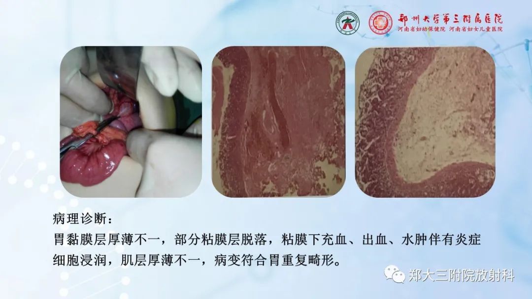 影像PPT - 【PPT】儿童腹部囊性病变诊断思路分析-36