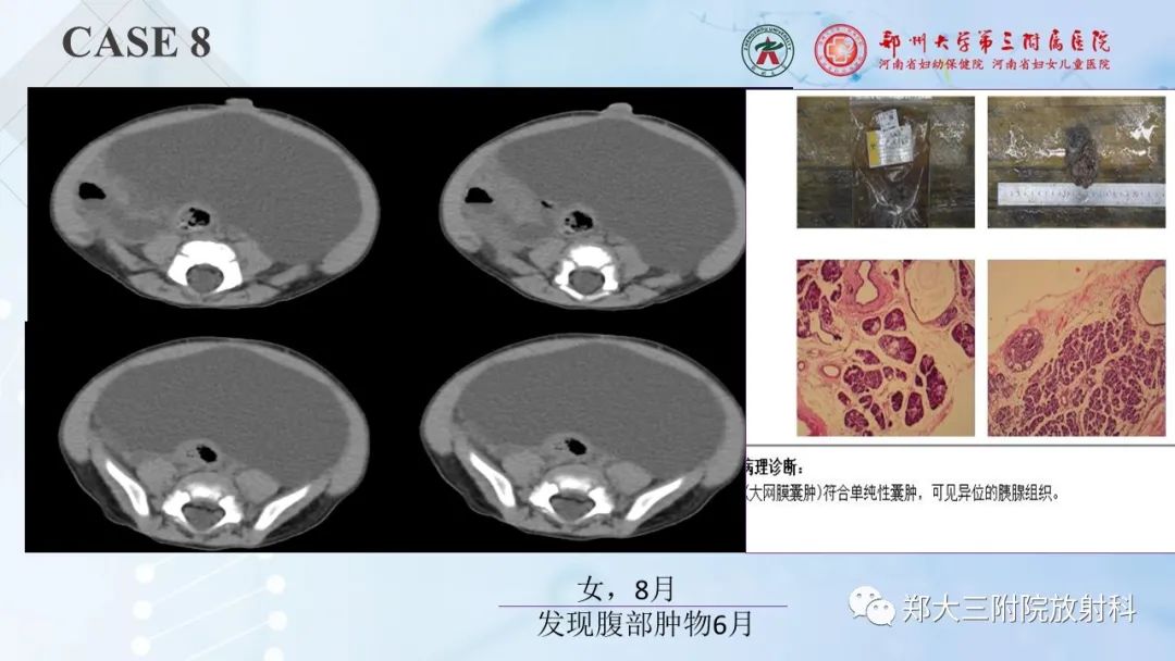 影像PPT - 【PPT】儿童腹部囊性病变诊断思路分析-29