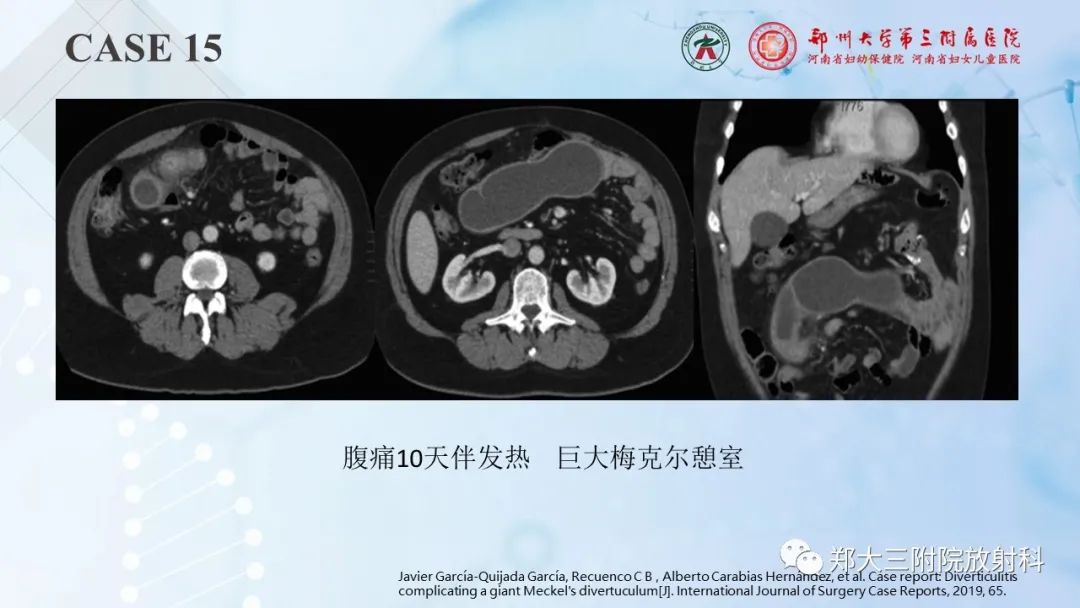影像PPT - 【PPT】儿童腹部囊性病变诊断思路分析-47