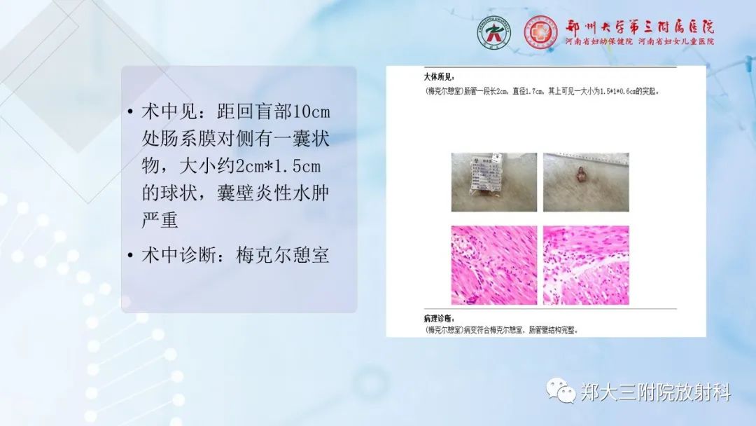 影像PPT - 【PPT】儿童腹部囊性病变诊断思路分析-46