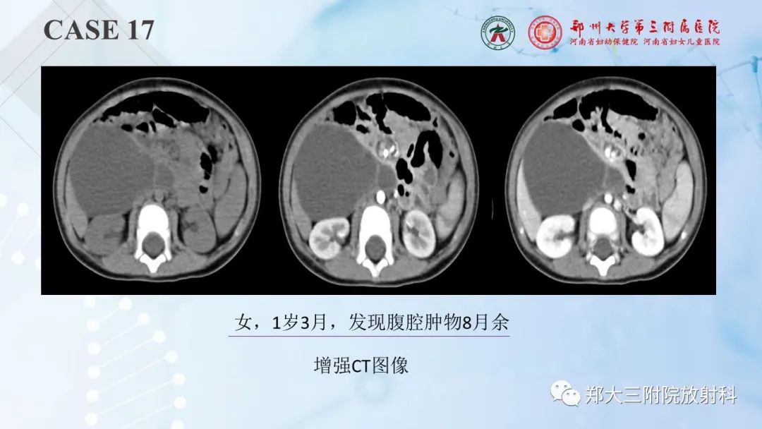 影像PPT - 【PPT】儿童腹部囊性病变诊断思路分析-51
