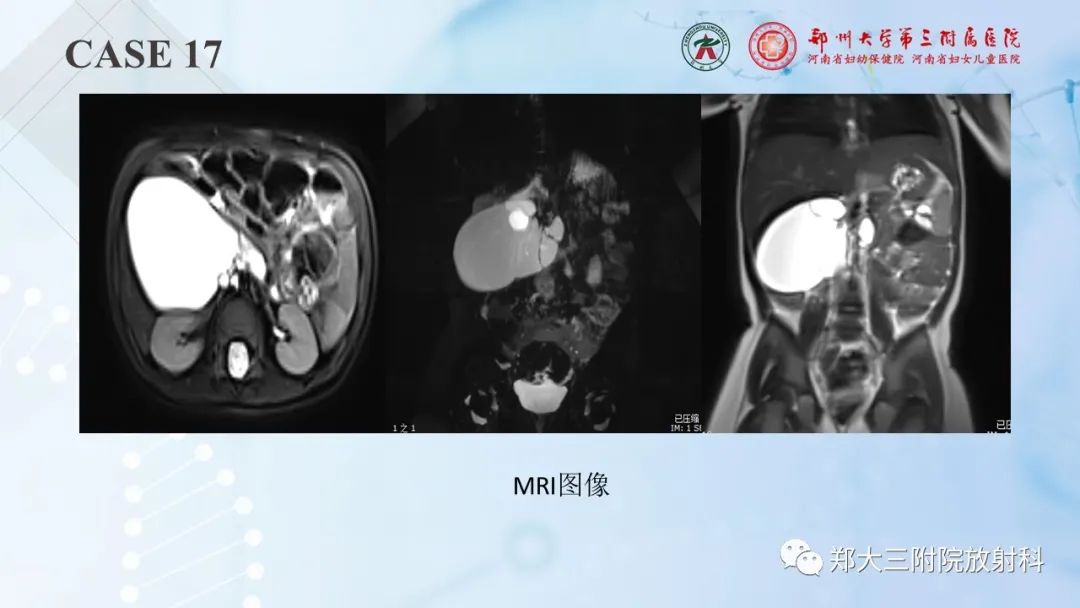 影像PPT - 【PPT】儿童腹部囊性病变诊断思路分析-52