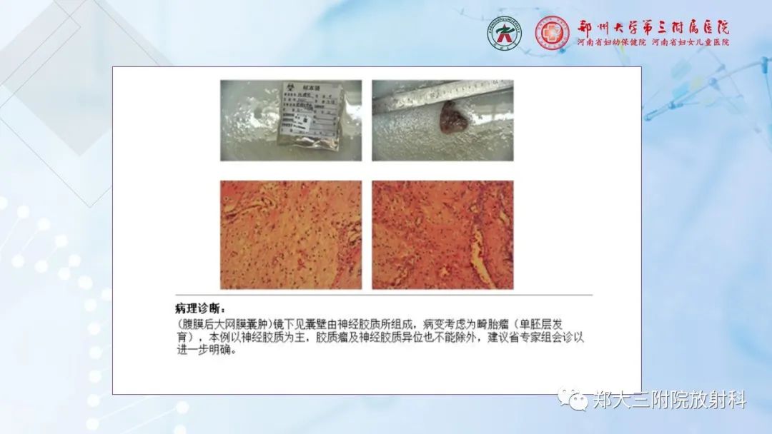 影像PPT - 【PPT】儿童腹部囊性病变诊断思路分析-53