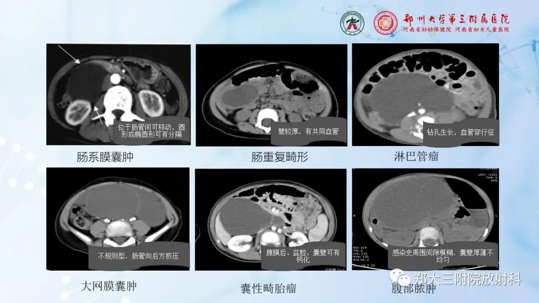 影像PPT - 【PPT】儿童腹部囊性病变诊断思路分析-56