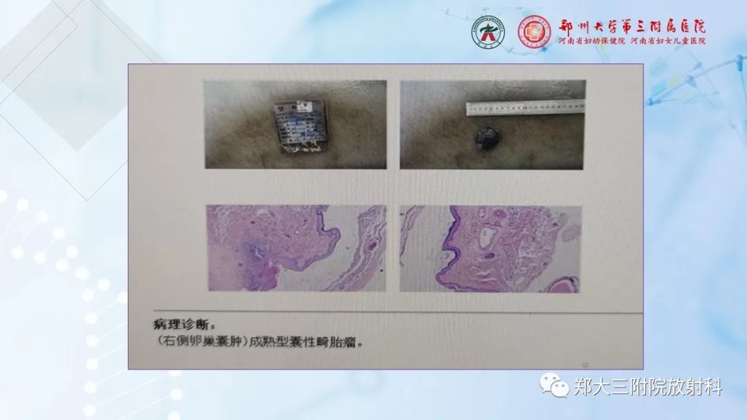 影像PPT - 【PPT】儿童腹部囊性病变诊断思路分析-55