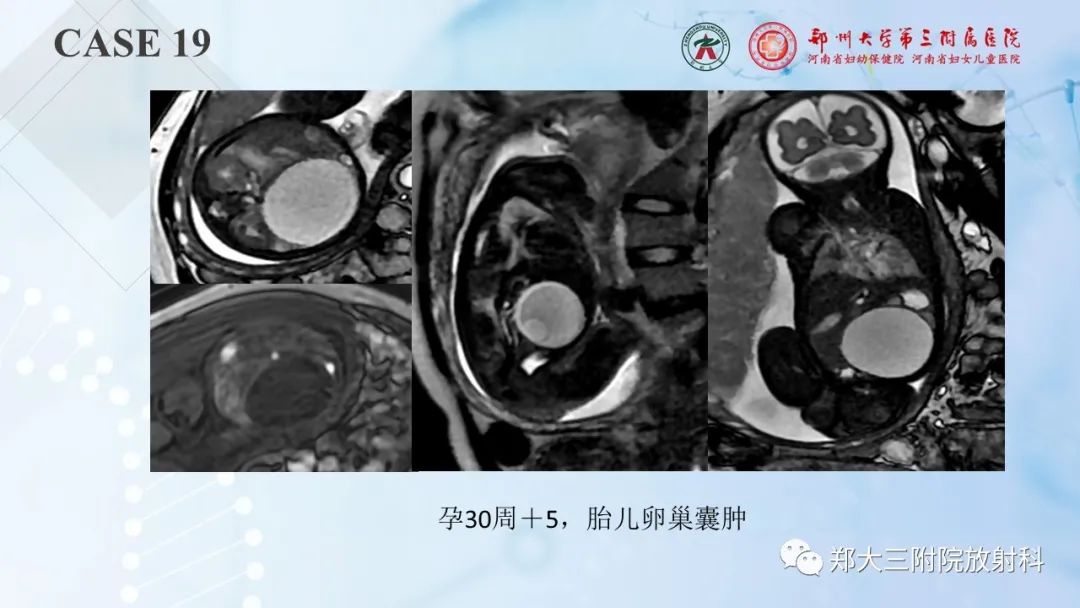 影像PPT - 【PPT】儿童腹部囊性病变诊断思路分析-60
