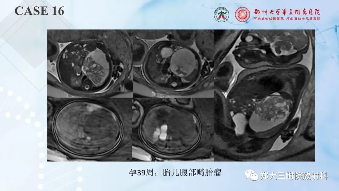影像PPT - 【PPT】儿童腹部囊性病变诊断思路分析-50