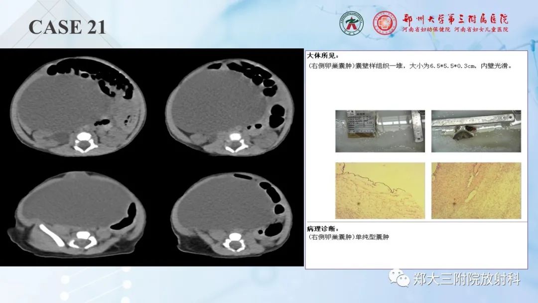 影像PPT - 【PPT】儿童腹部囊性病变诊断思路分析-62