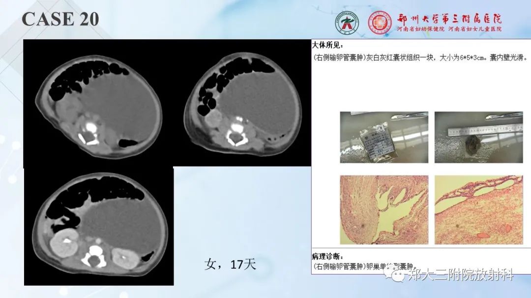 影像PPT - 【PPT】儿童腹部囊性病变诊断思路分析-61