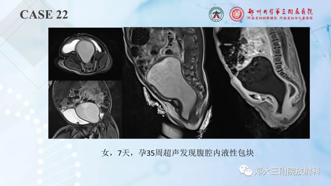 影像PPT - 【PPT】儿童腹部囊性病变诊断思路分析-64