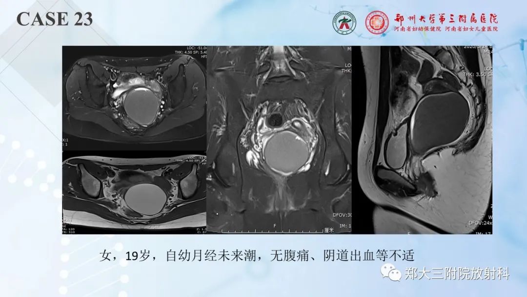 影像PPT - 【PPT】儿童腹部囊性病变诊断思路分析-66