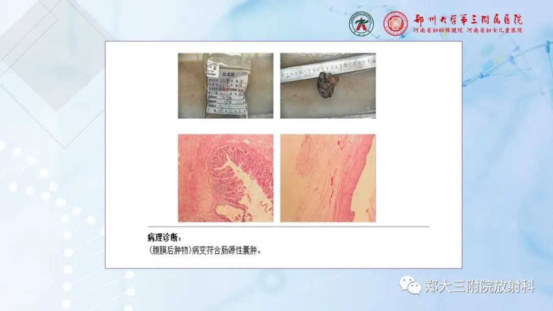 影像PPT - 【PPT】儿童腹部囊性病变诊断思路分析-39