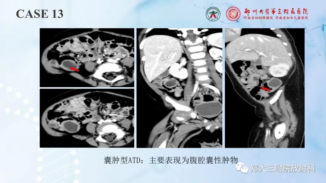 影像PPT - 【PPT】儿童腹部囊性病变诊断思路分析-41