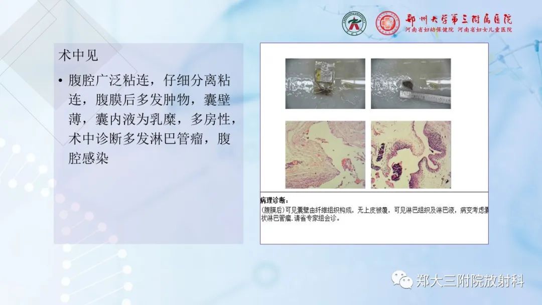 影像PPT - 【PPT】儿童腹部囊性病变诊断思路分析-20
