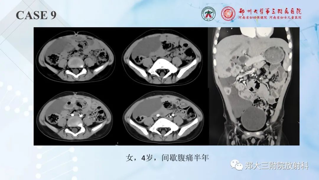 影像PPT - 【PPT】儿童腹部囊性病变诊断思路分析-30