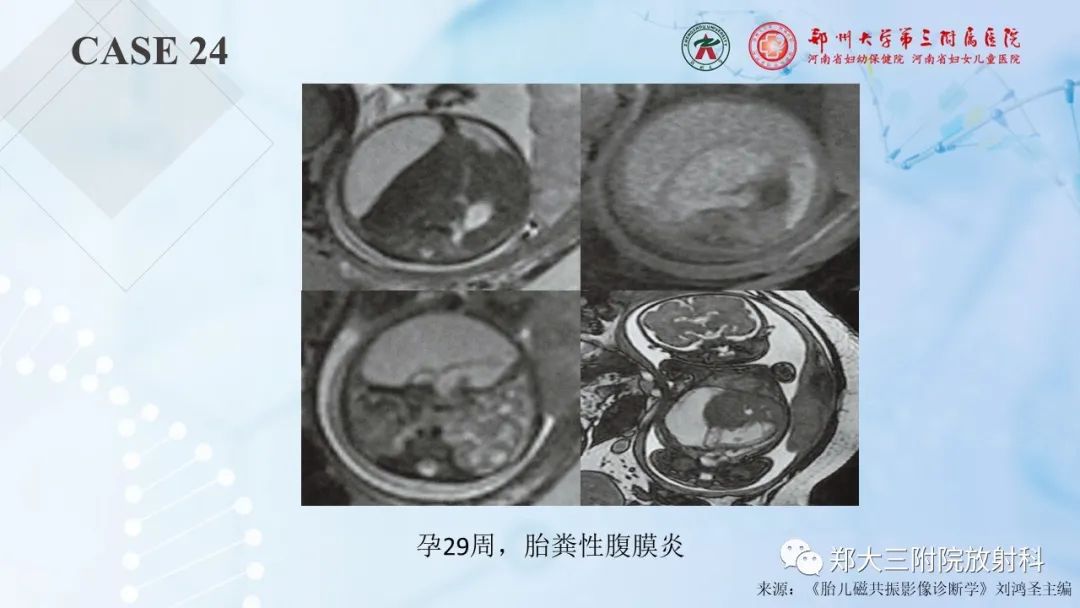 影像PPT - 【PPT】儿童腹部囊性病变诊断思路分析-71