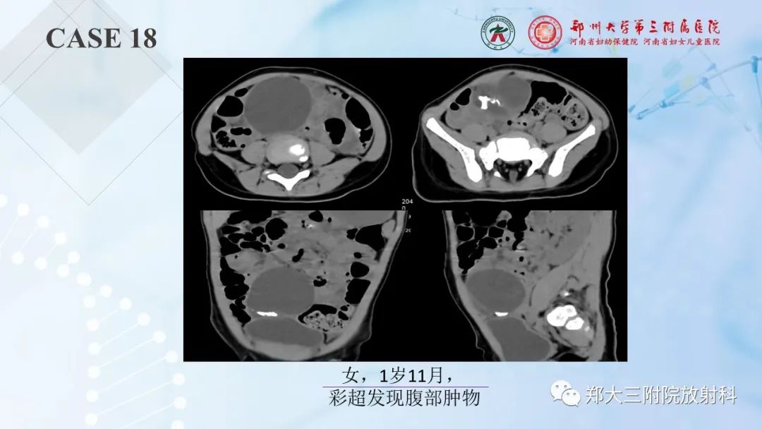 影像PPT - 【PPT】儿童腹部囊性病变诊断思路分析-54