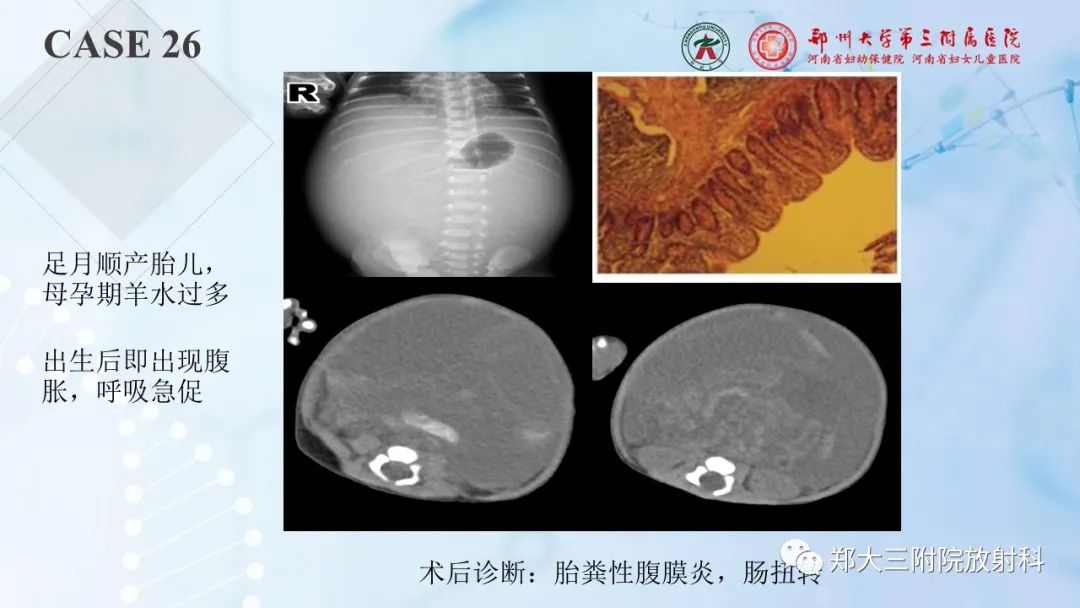 影像PPT - 【PPT】儿童腹部囊性病变诊断思路分析-73