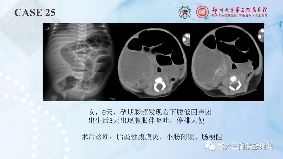 影像PPT - 【PPT】儿童腹部囊性病变诊断思路分析-72