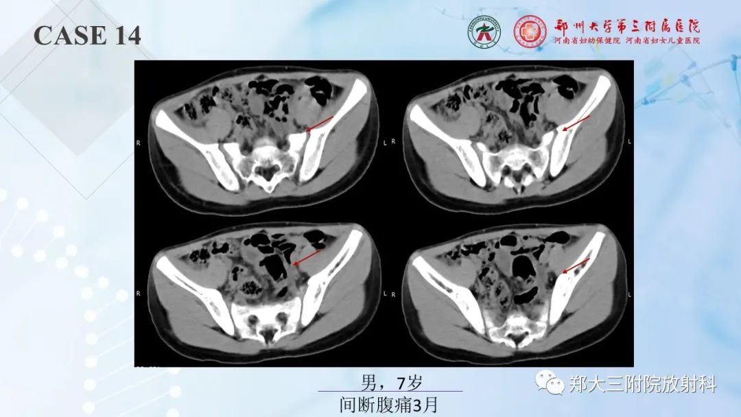 影像PPT - 【PPT】儿童腹部囊性病变诊断思路分析-44
