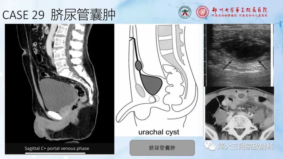 影像PPT - 【PPT】儿童腹部囊性病变诊断思路分析-79