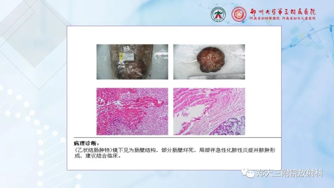 影像PPT - 【PPT】儿童腹部囊性病变诊断思路分析-77