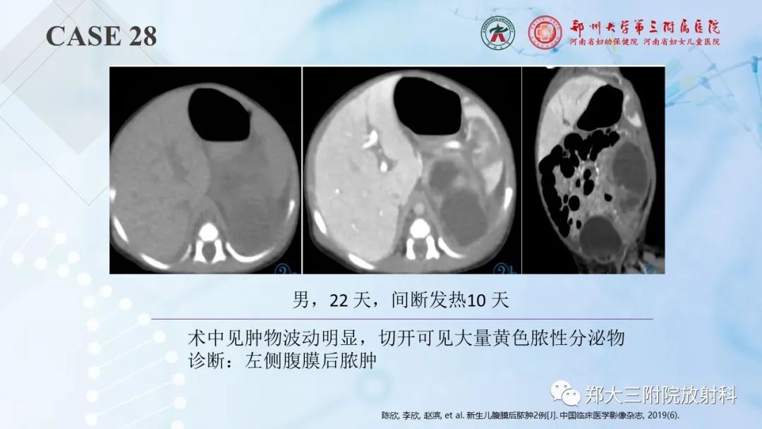 影像PPT - 【PPT】儿童腹部囊性病变诊断思路分析-78