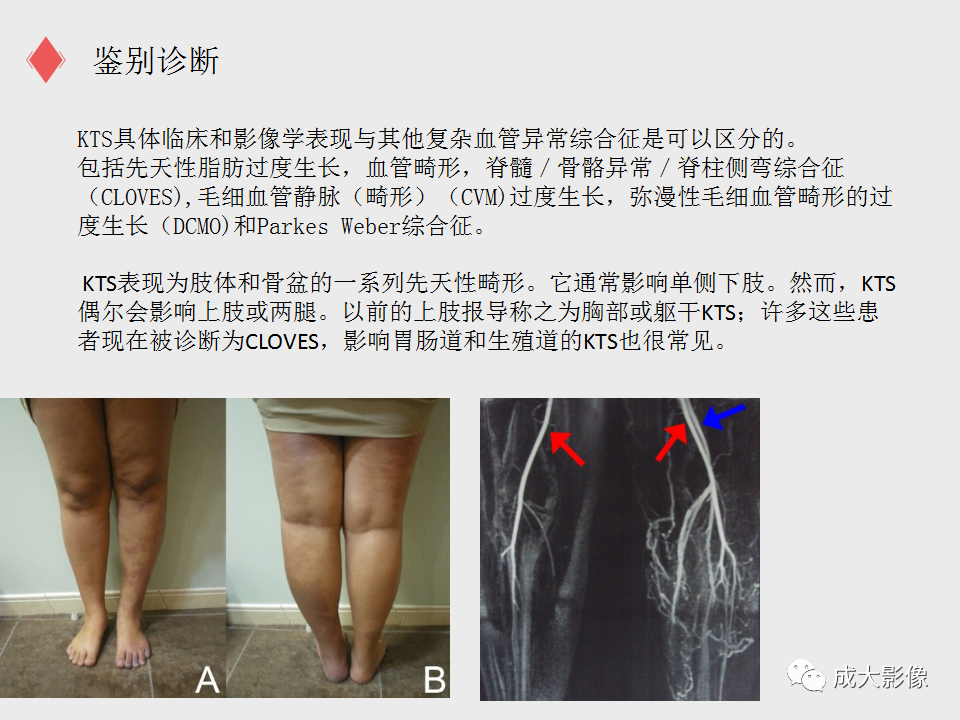 影像PPT - 【PPT】Klippel Trenaunay综合征-10