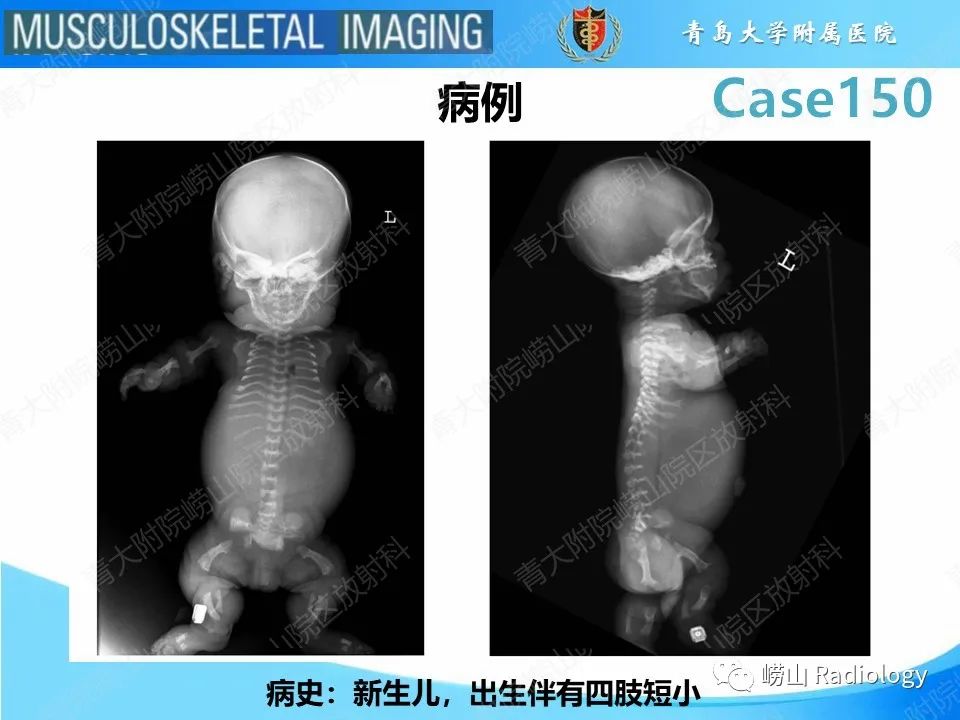 影像PPT - 【PPT】致死性发育不良1型-2