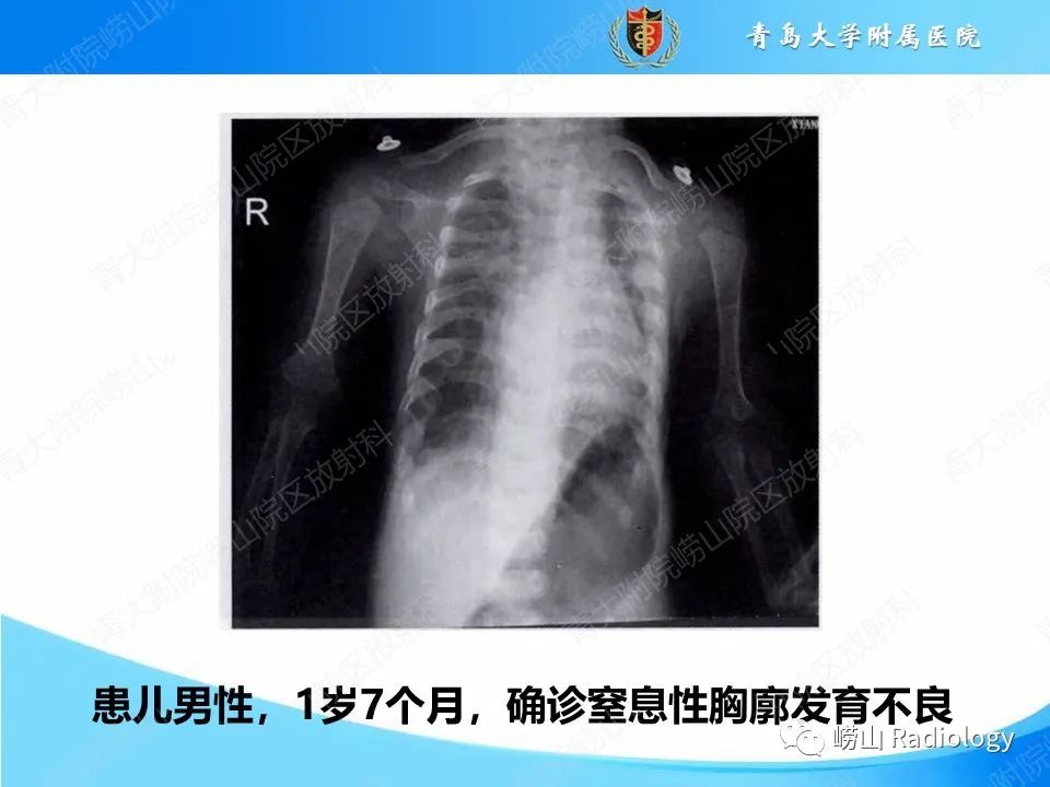 影像PPT - 【PPT】致死性发育不良1型-13