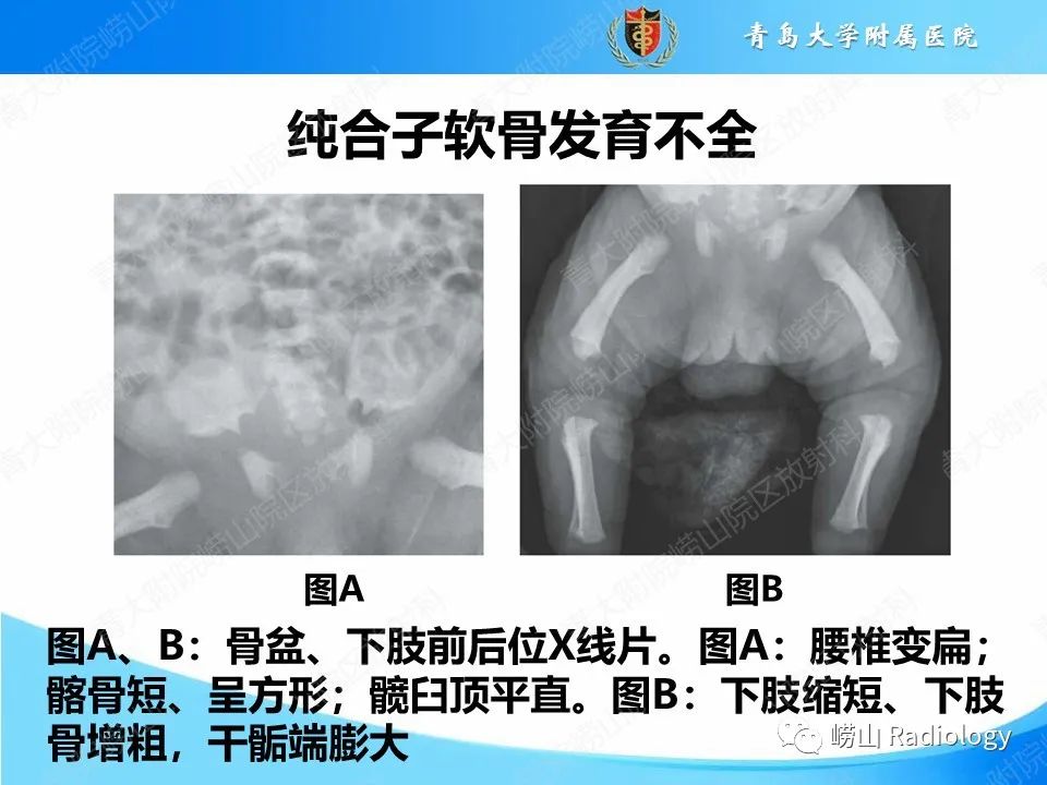影像PPT - 【PPT】致死性发育不良1型-15