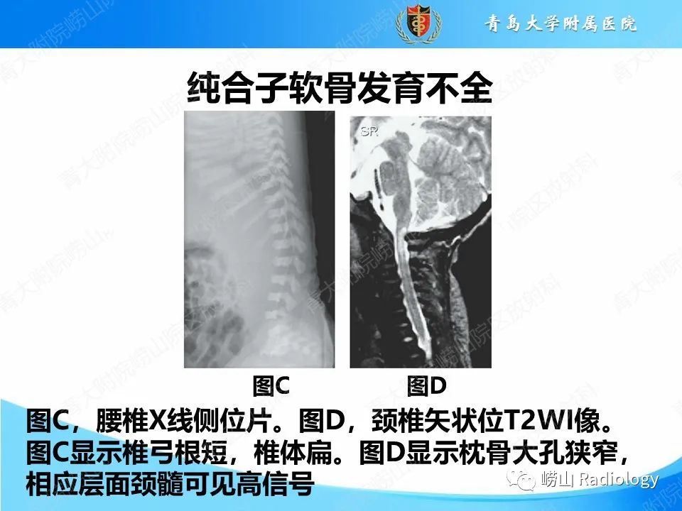 影像PPT - 【PPT】致死性发育不良1型-16