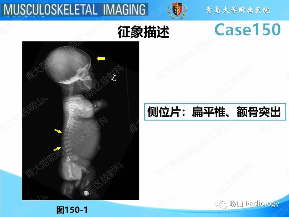 影像PPT - 【PPT】致死性发育不良1型-19