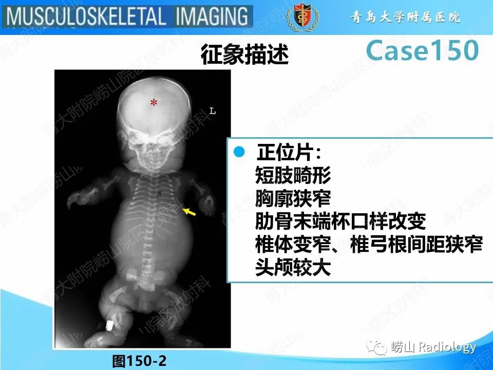 影像PPT - 【PPT】致死性发育不良1型-20