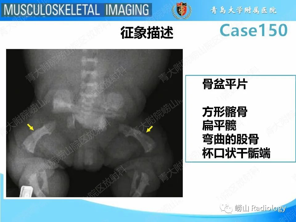 影像PPT - 【PPT】致死性发育不良1型-21