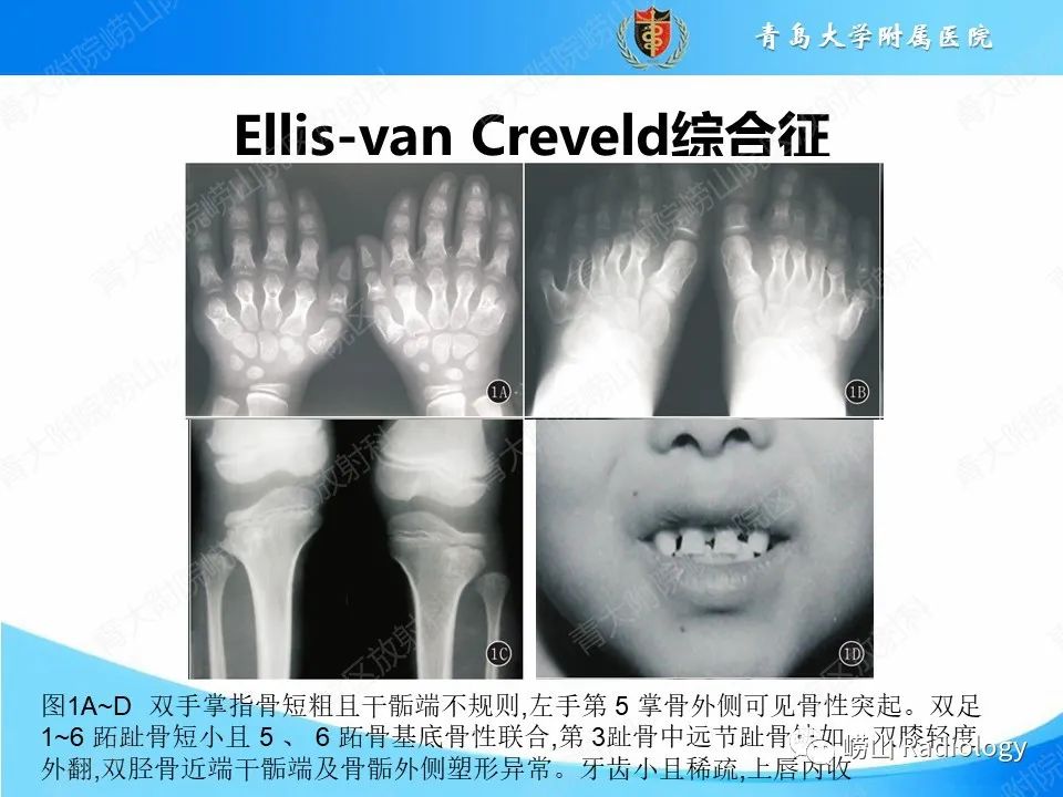 影像PPT - 【PPT】致死性发育不良1型-18