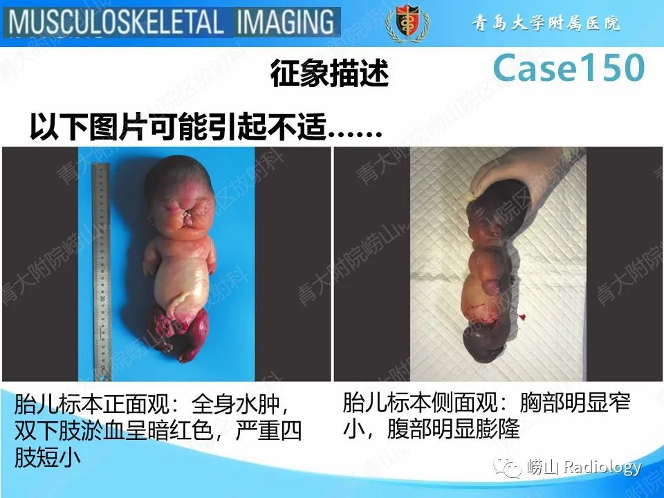 影像PPT - 【PPT】致死性发育不良1型-22