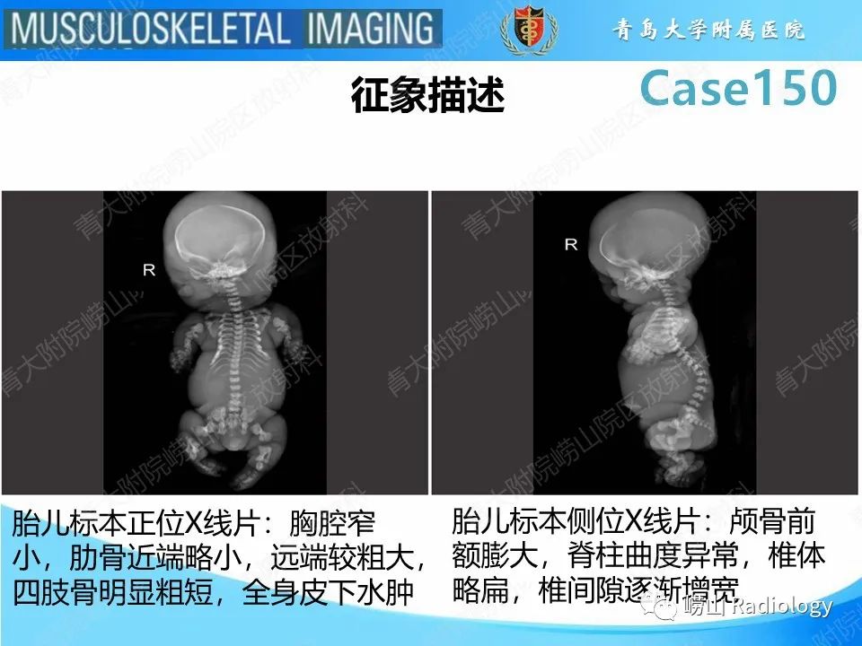 影像PPT - 【PPT】致死性发育不良1型-23