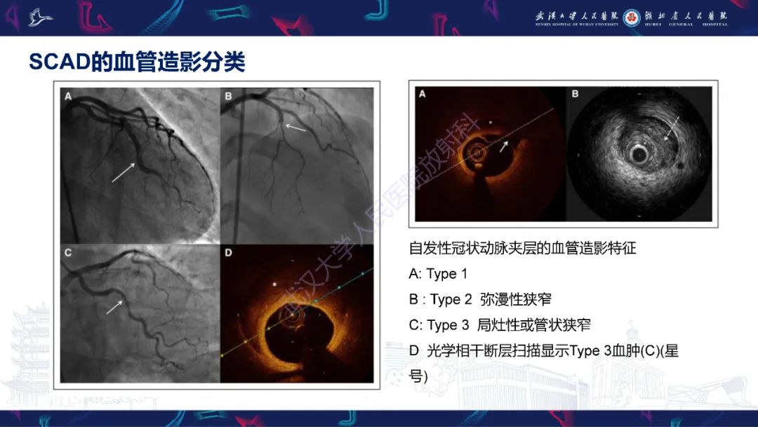 影像PPT - 【PPT】自发性冠状动脉夹层影像诊断-9