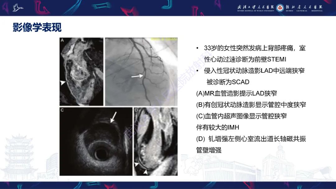 影像PPT - 【PPT】自发性冠状动脉夹层影像诊断-12