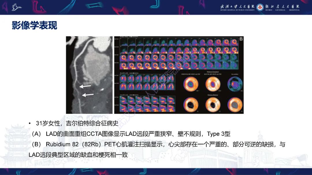 影像PPT - 【PPT】自发性冠状动脉夹层影像诊断-13