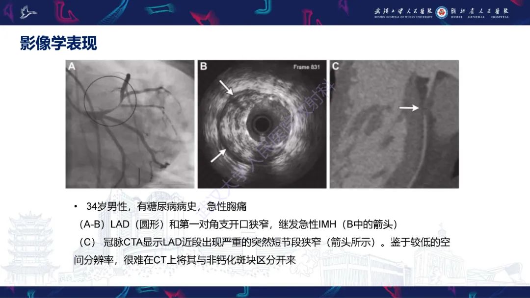 影像PPT - 【PPT】自发性冠状动脉夹层影像诊断-14