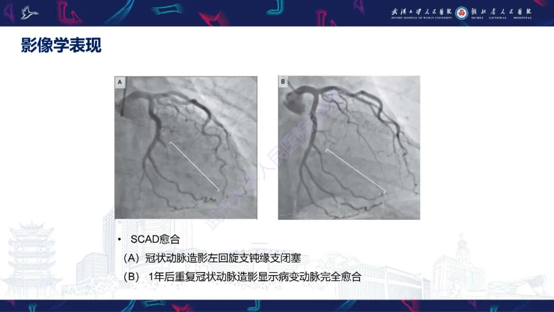 影像PPT - 【PPT】自发性冠状动脉夹层影像诊断-15