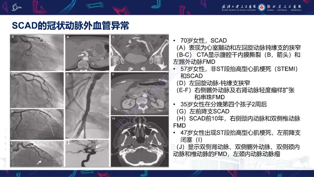 影像PPT - 【PPT】自发性冠状动脉夹层影像诊断-16