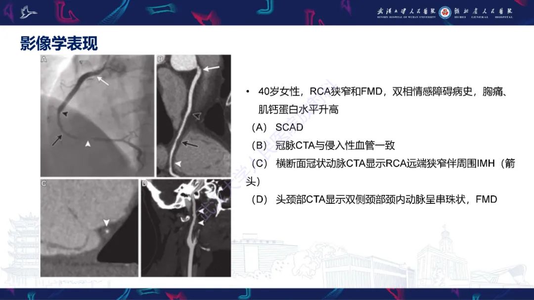 影像PPT - 【PPT】自发性冠状动脉夹层影像诊断-18