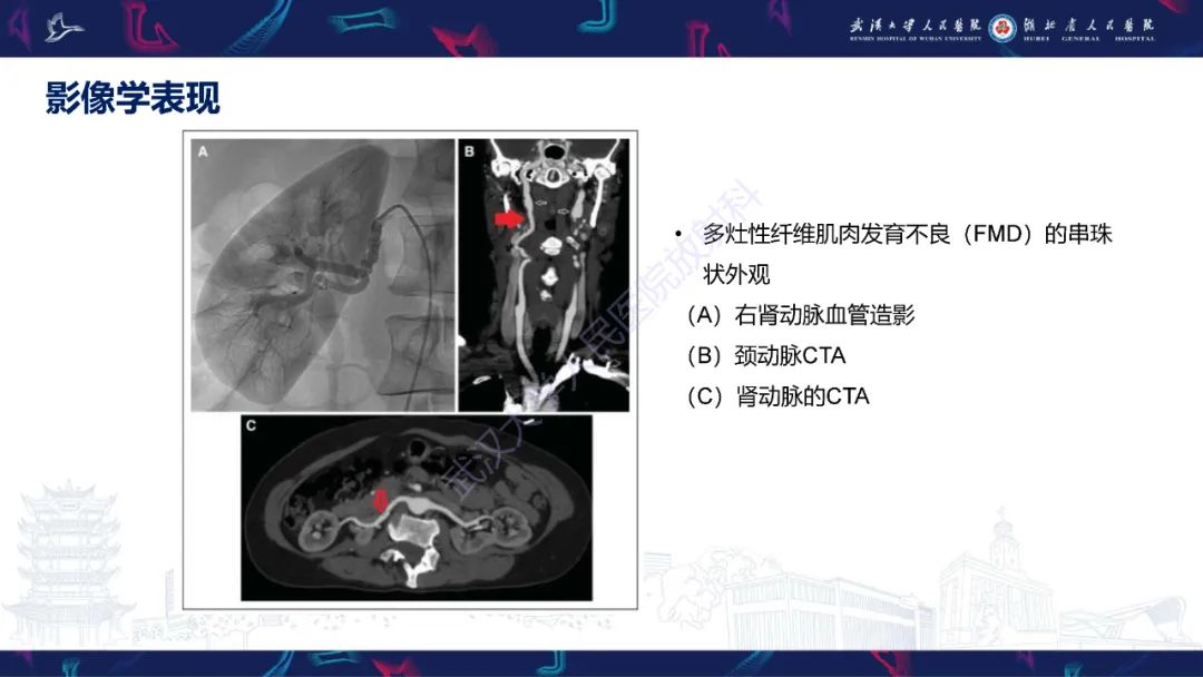 影像PPT - 【PPT】自发性冠状动脉夹层影像诊断-19