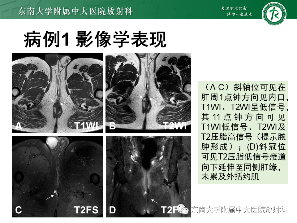 影像PPT - 【PPT】肛瘘的MR诊断-2