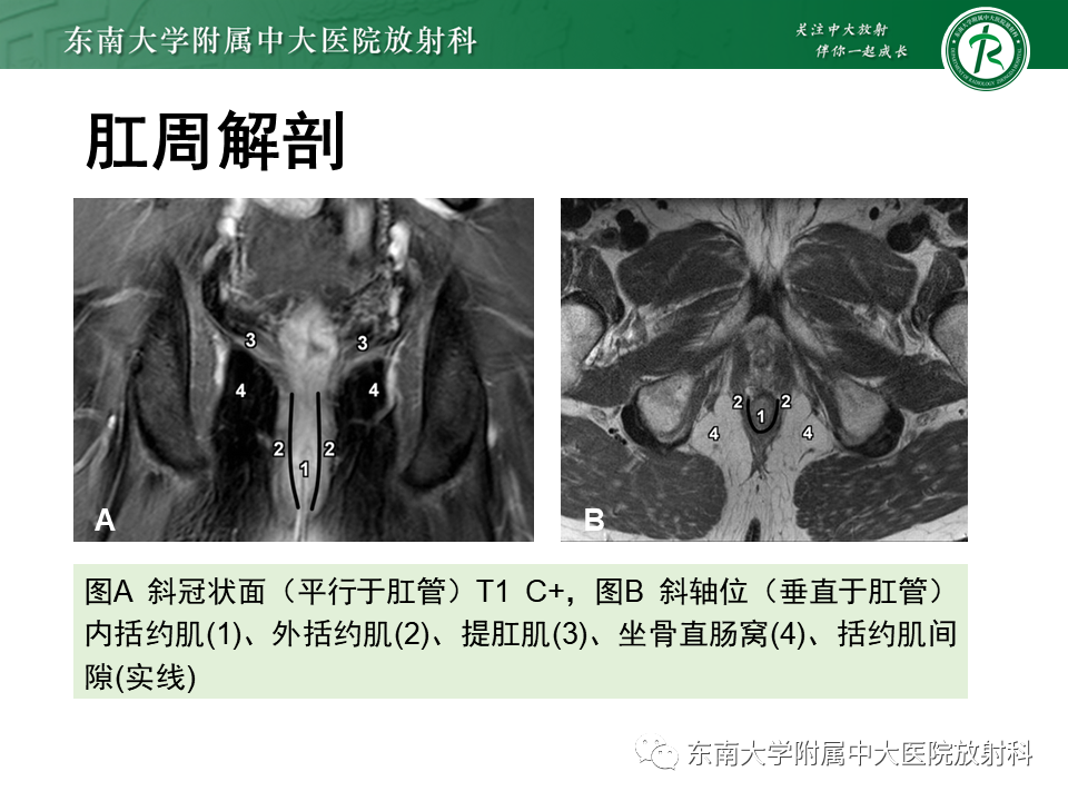 影像PPT - 【PPT】肛瘘的MR诊断-10