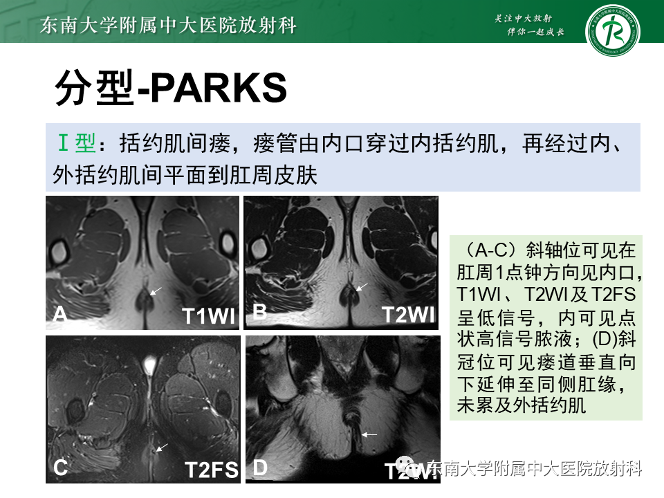 影像PPT - 【PPT】肛瘘的MR诊断-18