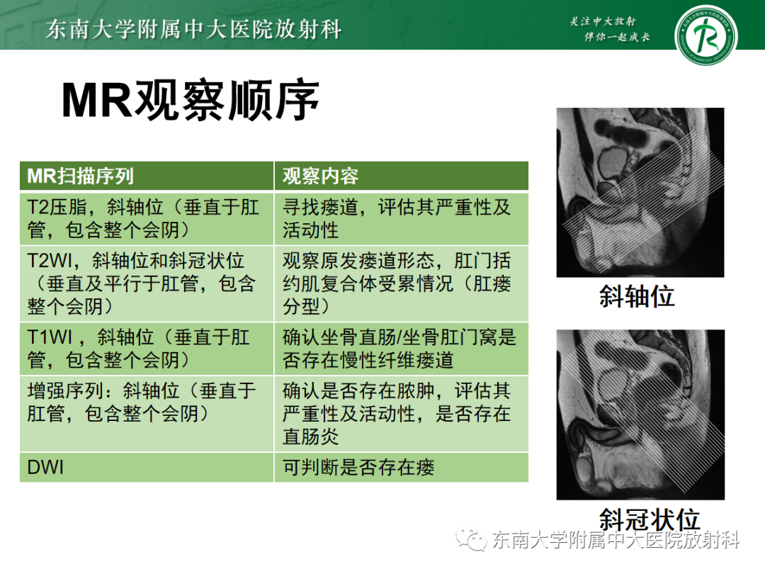 影像PPT - 【PPT】肛瘘的MR诊断-14
